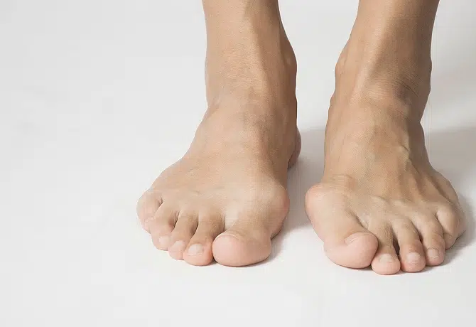 HALLUX RIGIDUS